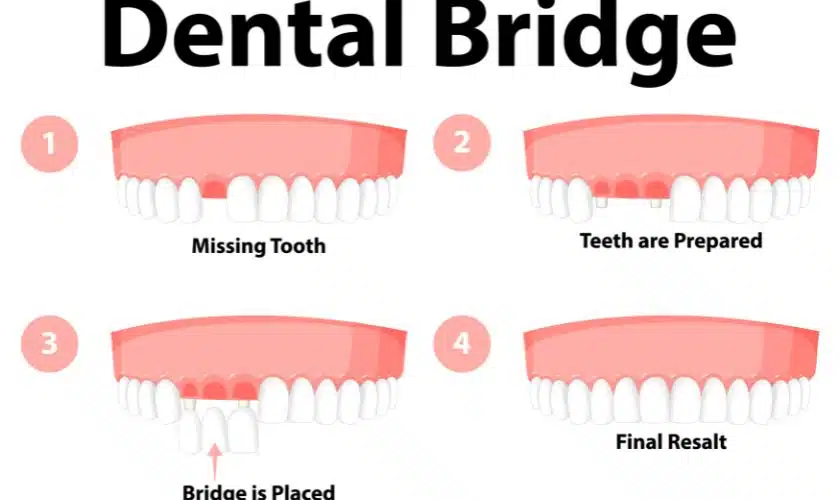 Getting Your Smile Back: How Dental Bridges Can Help - Old Settlers Dental