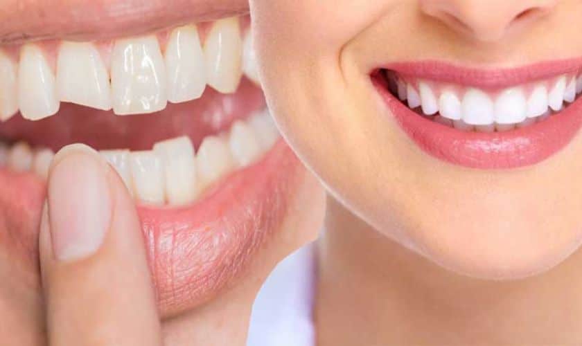 Teeth Bonding: A Simple Solution for a Radiant Smile - Old Settlers Dental - Round Rock Dentist