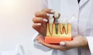 Dental Implants Round Rock
